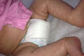 ทารกตัวลาย ทารกผิวลาย Cutis Marmorata อันตรายหรือไม่