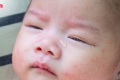 ลูกทารกเป็นท่อน้ำตาตัน ท่อน้ำตาอักเสบ ต้องดูแลอย่างไร