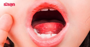 เฮอร์แปงไจนา โรคตุ่มแผลในปากเด็ก