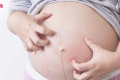 4 อาการคันของคนท้อง ลุกลามแย่แน่ถ้าไม่ท้องไม่รีบรักษาและป้อง ...
