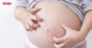 4 อาการคันของคนท้อง ลุกลามแย่แน่ถ้าไม่ท้องไม่รีบรักษาและป้องกัน