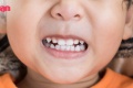 แพทย์แนะนำ เด็กควร 'จัดฟัน' ตอนอายุเท่าไหร่ ถึงเหมาะสมที่สุด