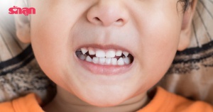 แพทย์แนะนำ เด็กควร 'จัดฟัน' ตอนอายุเท่าไหร่ ถึงเหมาะสมที่สุด
