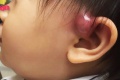 Ear pit อักเสบ ภัยเงียบของเด็กมีรูเล็ก ๆ ข้างหู