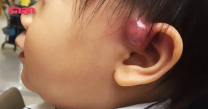 Ear pit อักเสบ ภัยเงียบของเด็กมีรูเล็ก ๆ ข้างหู