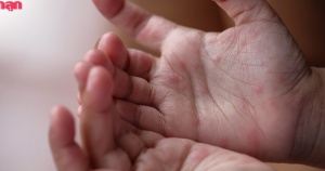 สาธารณสุขเตือนพ่อแม่ เด็กป่วย มือ เท้า ปาก เดือนละ 10,000 ราย