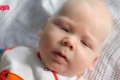ทารกผิวเผือก มารู้จักกับโรค Albinism หรือคนผิวเผือกกันเถอะ