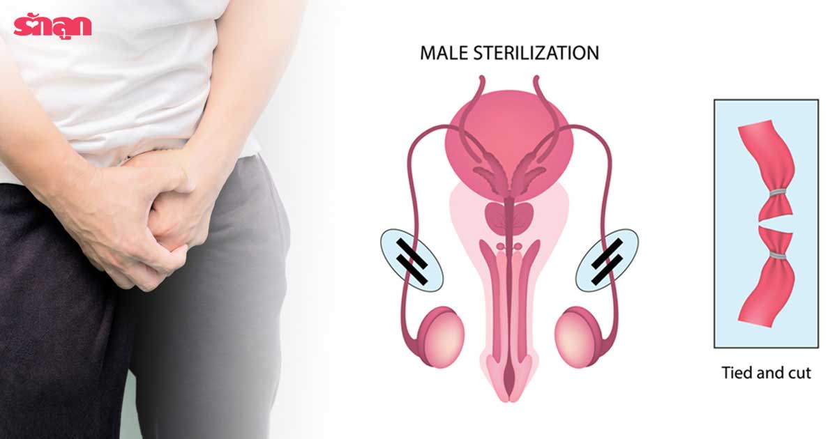 ทำหมันชาย, วิธีทำหมันชาย, ทำหมันชายเจ็บไหม, ทำหมันชายแล้วจะหมดอารมณ์ทางเพศไหม, ทำหมันชายแล้วจะหมดสมรรถภาพทางเพศไหม, หมันชาย เซ็กเสื่อม, หมันชาย ทำยังไง, ขั้นตอน หมันชาย, หมันชาย ตัดท่อนำอสุจิ, ผูกท่ออสุจิ, คุมกำเนิดผู้ชาย
