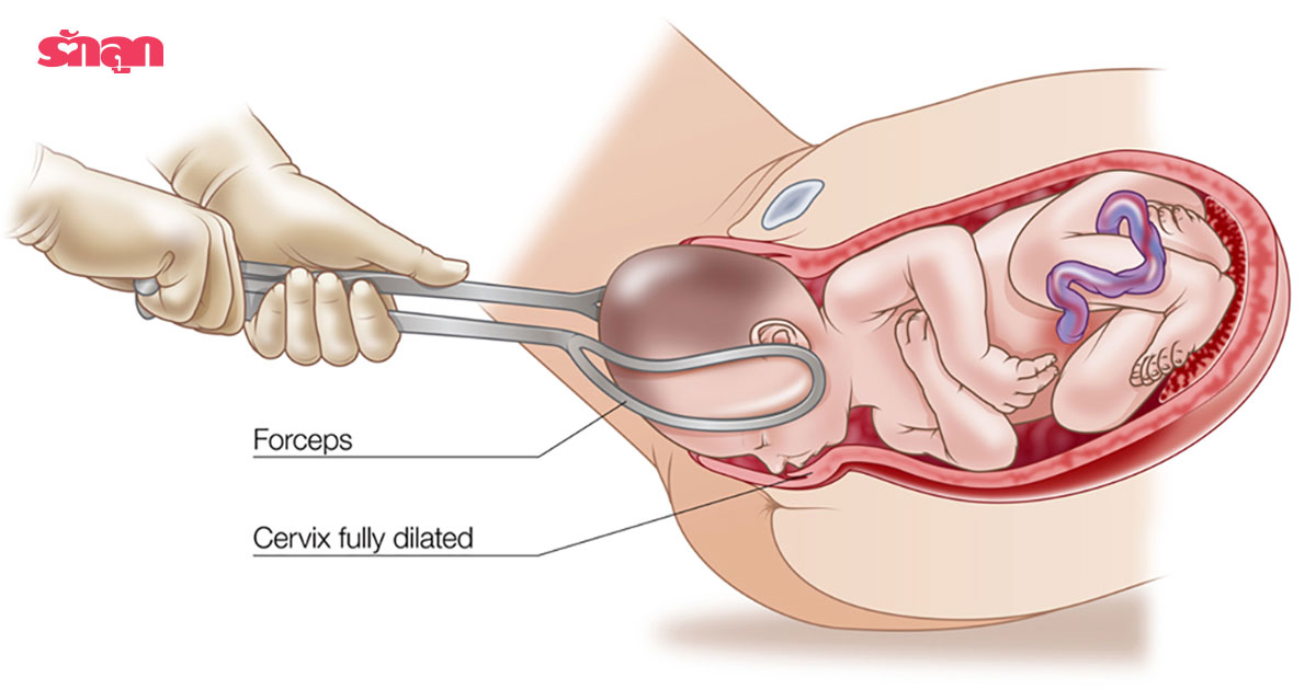 คีมช่วยทำคลอด, คีมคลอดลูก, ใช้คีมช่วยคลอด, คีมคีบหัวช่วยคลอด, อุปกรณ์ช่วยคลอด, อุปกรณ์ทำคลอด, คลอดลูกด้วยวิธีธรรมชาติ, แม่ไม่มีแรงเบ่งคลอด, Forceps, ช่วยคลอดด้วยคีม, ทำไมต้องใช้คีมช่วยคลอด, คีมช่วยคลอด อันตรายไหม, คีมช่วยคลอด สมองเด็ก, คีมช่วยคลอด คืออะไร