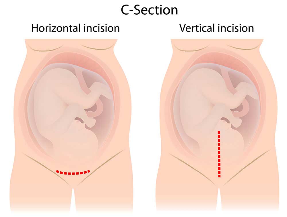 แผลผ่าคลอด, แผลผ่าตัดคลอดลูก, แผล ผ่าตัด คลอด ลูก กี่ วัน หาย, แผล ผ่า คลอด อักเสบ, ดูแลแผลคลอด, แผลคลอด ไม่เป็นแผลเป็น แผลสวย, แผลผ่าคลอด จะเป็นแผลเป็นไหม, รอยนูน แผลผ่าคลอด, รอยผ่าคลอด, C-section