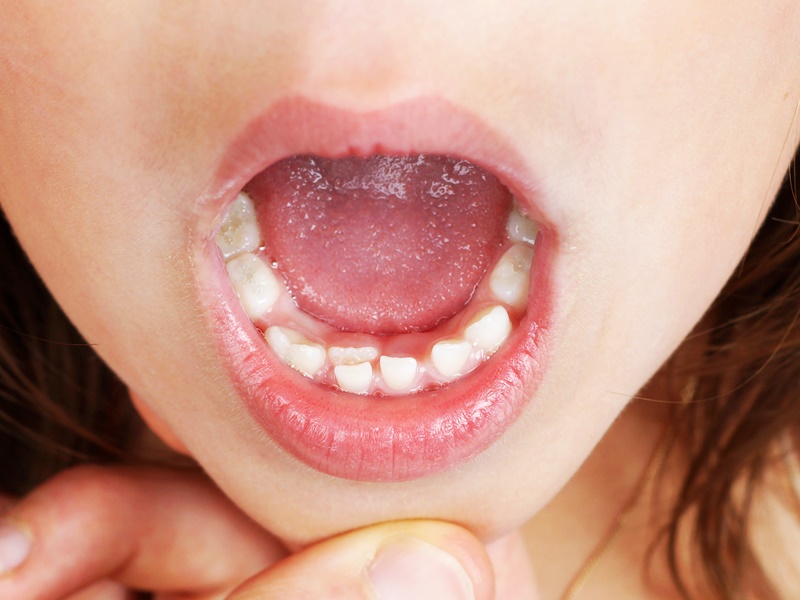 ปัญหาฟัน- ฟันซ้อน-ฟันซ้อนคืออะไร- สาเหตุฟันซ้อน-ฟันน้ำนม-ฟันแท้- ลูกปวดฟัน- ลูกเจ็บตรงฟันซ้อน- ฟันซ้อนอันตรายไหม- ฟันซ้อนแบบไหนอันตราย