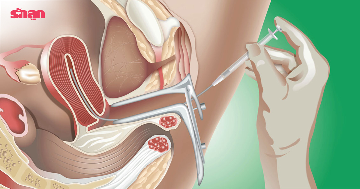 IUI, การฉีดเชื้อผสมเทียมในโพรงมดลูก, Intrauterine Insemination-IUI, อยากมีลูก, มีลูกยาก, ผสมเทียม, ฉีดน้ำเชื้อ, เด็กหลอดแก้ว, มีลูกยาก ทำอย่างไร, ตัวช่วยมีบุตร, ผสมเทียม ราคาไม่แพง, วิธีผสมเทียม