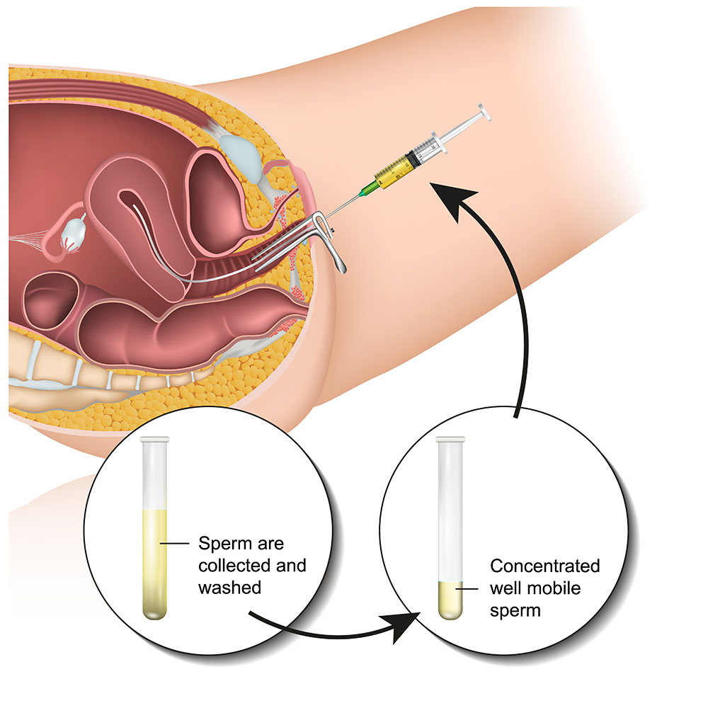 IUI, การฉีดเชื้อผสมเทียมในโพรงมดลูก, Intrauterine Insemination-IUI, อยากมีลูก, มีลูกยาก, ผสมเทียม, ฉีดน้ำเชื้อ, เด็กหลอดแก้ว, มีลูกยาก ทำอย่างไร, ตัวช่วยมีบุตร, ผสมเทียม ราคาไม่แพง, วิธีผสมเทียม