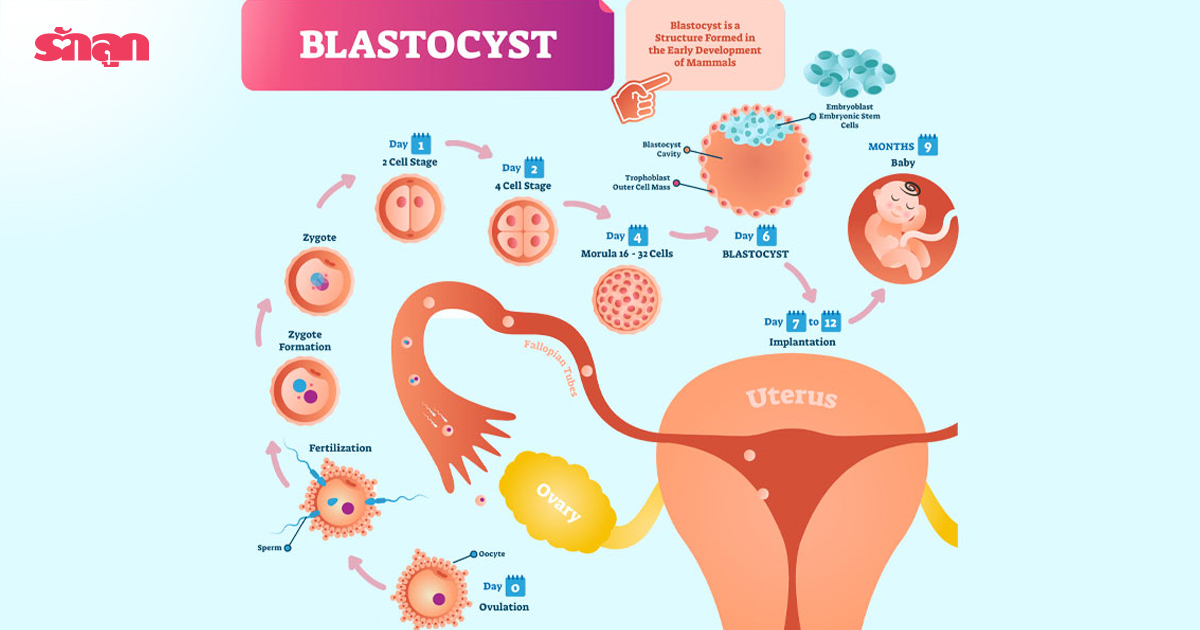 Blastocyst Culture, บลาสโตซิสท์ คัลเจอร์, ผสมเทียม, เด็กหลอดแก้ว, มีลูกยาก, การผสมเทียม มีลูก, รักษา มีลูกยาก, มีบุตรยาก รักษายังไง