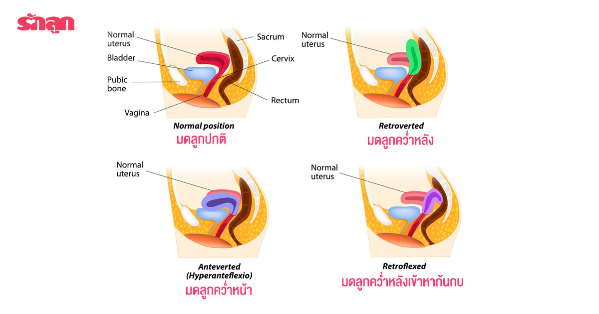 มดลูกคว่ำมดลูกคว่ำ, มดลูกคว่ำ ผิดปกติไหม, มดลูกคว่ำ มีลูกยาก, มดลูกคว่ำ อยากมีลูก, มดลูกคว่ำ มีลูกได้ไหม, ทำไมมดลูกคว่ำ, มดลูกปกติเป็นยังไง, มดลูกผิดปกติ, มดลูกมีปัญหา, มีลูกยาก, อยากมีลูก, มี ลูก ยาก, มี บุตร ยาก