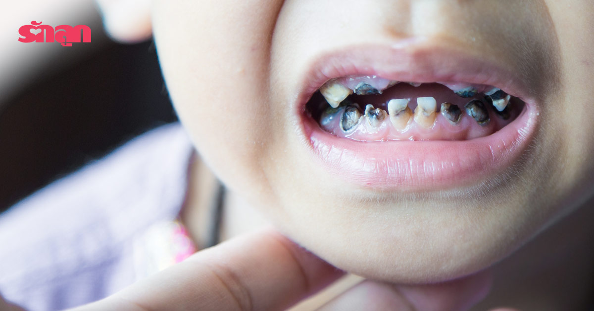 การเลี้ยงลูก-พัฒนาการ-สอนลูก-แปรงฟัน-ฟันผุ-ลูกฟันผุ