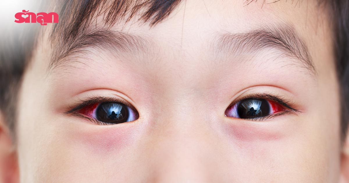 ตาแดง, โรคตาแดง, ลูกเป็นตาแดง, ตาแดงต้องทำอย่างไร, ตาแดงหรือไม่, ตาแดงในเด็ก, โรคตา, โรคตาในเด็ก