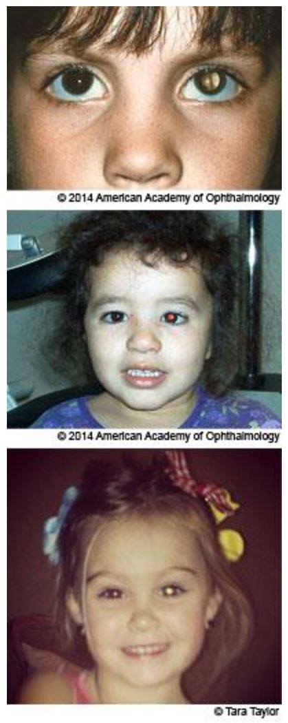 หยิบกล้องขึ้นมา! ถ่ายรูปเด็กตาเป็นแบบนี้ สัญญาณเตือนโรคมะเร็งจอประสาทตาเด็ก-ถ่ายรูปแล้วมีแสงสะท้อนผิดปรกติ-สัญญาณมะเร็งจอตา-สัญญาณมะเร็งจอประสาทตา-ตาแดง 1 ข้าง-มะเร็งจอประสาทตา-โรคมะเร็งจอประสาทตา-อาการโรคมะเร็งจอประสาทตา-การรักษาโรคมะเร็งจอประสาทตา-มะเร็งจอตา-มะเร็งดวงตา-มะเร็งเด็ก-มะเร็งตาเด็ก-ถ่ายรูปตาผิดปกติ-ถ่ายรูปสะท้อนตาแดง-ถ่ายรูปแล้วตาขาว-ถ่ายรูปเด็กแต่สายตาผิดปกติ-ถ่ายรูปเด็กแล้วตาแดง 1 ข้าง-สายตาลูกผิดปกติ