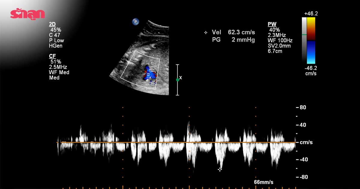 หัวใจของลูกในท้อง-ลูกในท้องเป็นโรคหัวใจไหม-วิธีตรวจความเสี่ยงทารกเป็นโรคหัวใจ-อัลตราซาวนด์หัวใจทารก-วิธีตรวจโรคหัวใจลูกในท้อง