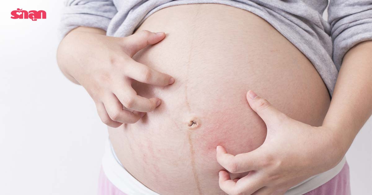 ผื่นคนท้อง-ผื่นขณะตั้งครรภ์-ครีมทาแก้ผื่นคัน-ทำไมคนท้องเป็นผื่นคัน-ครีมทาท้องลาย-คนท้องคันช่องคลอด