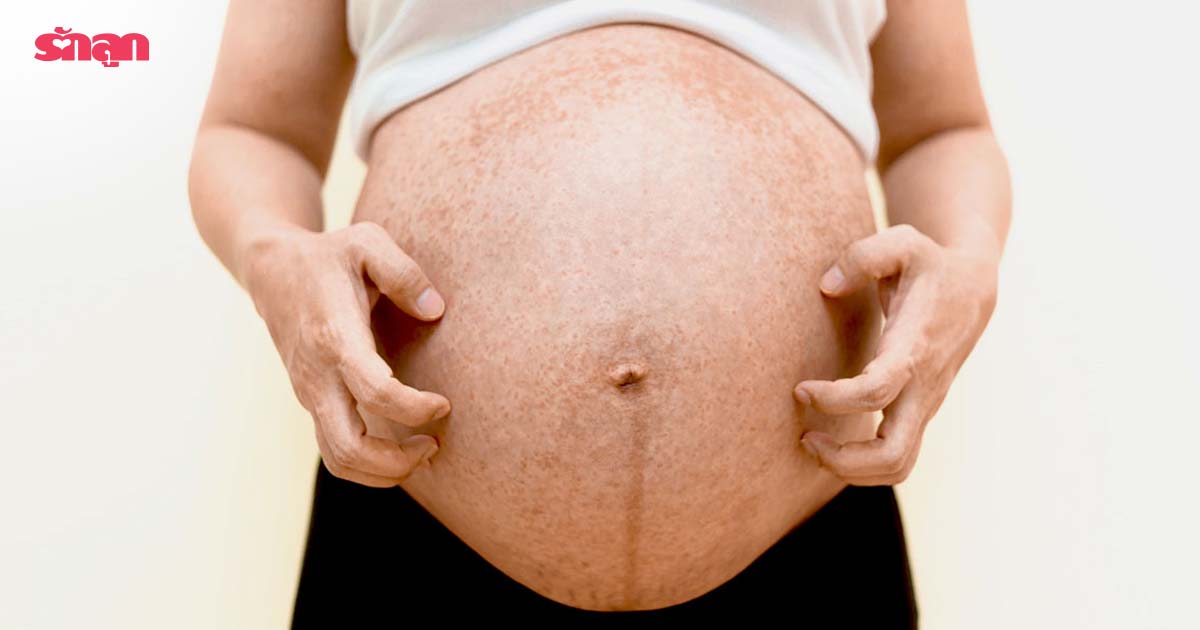 ผื่นคนท้อง-แม่ท้องเป็นผื่นคัน-รักษาผื่นคนท้อง