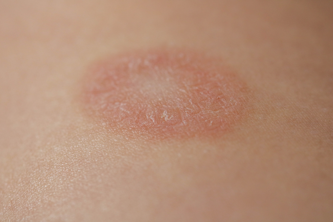 Pityriasis Rosea is a type of dermatitis with a mild pink or red skin rash and a flaky rash, maternal plaque, the first biggest papula. Gibera Syndrome.