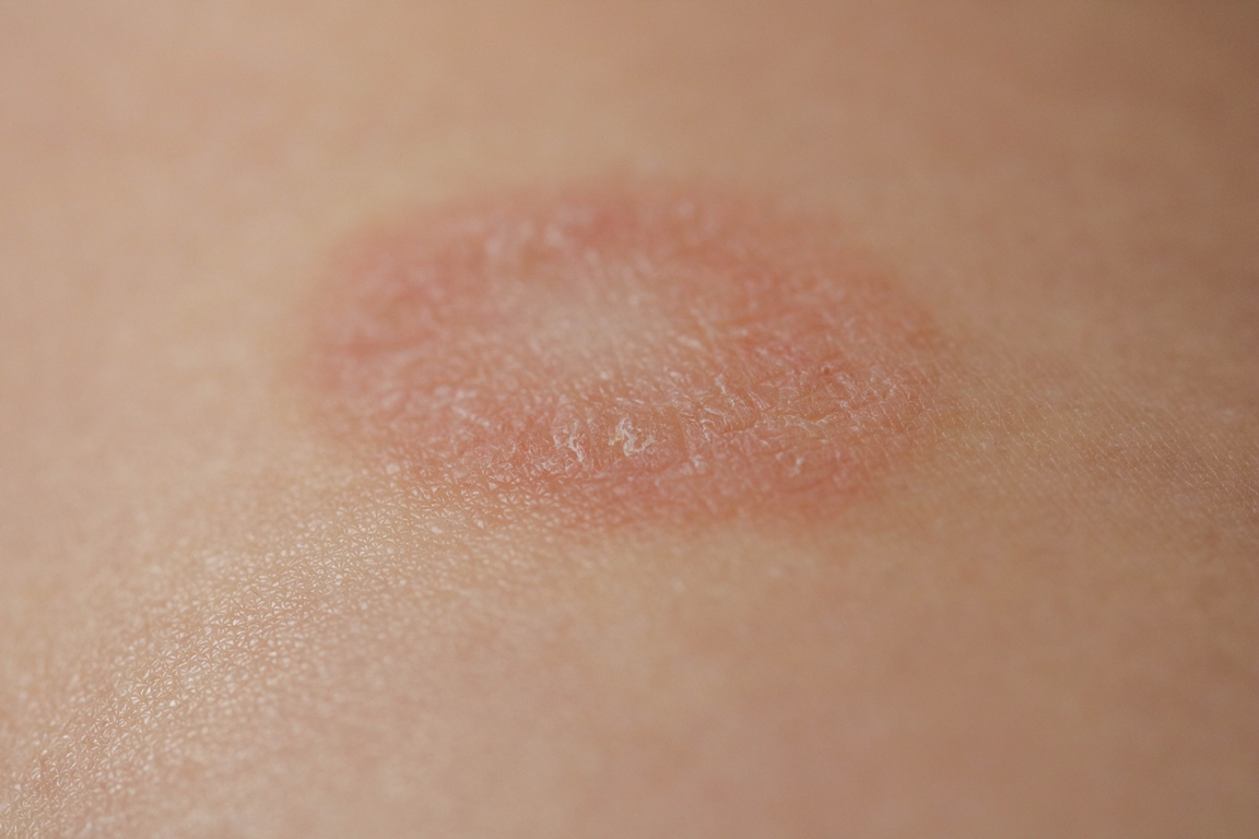 Pityriasis Rosea is a type of dermatitis with a mild pink or red skin rash and a flaky rash, maternal plaque, the first biggest papula. Gibera Syndrome.