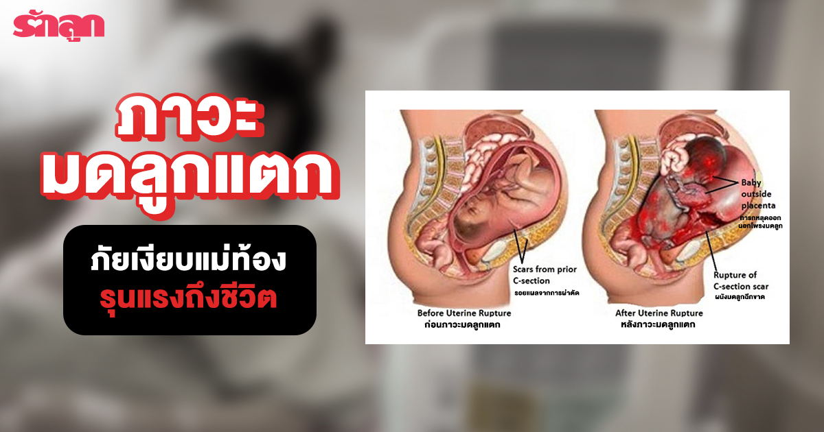 มดลูกแตก-ภาวะมดลูกแตก-สัญญาณเตือนภาวะมดลูกแตก-มดลูกแตกมาแล้วจะมีลูกได้มั้ย-เคยผ่าตัดมดลูก มีลูกได้มั้ย-ครรภ์เสี่ยงสูง