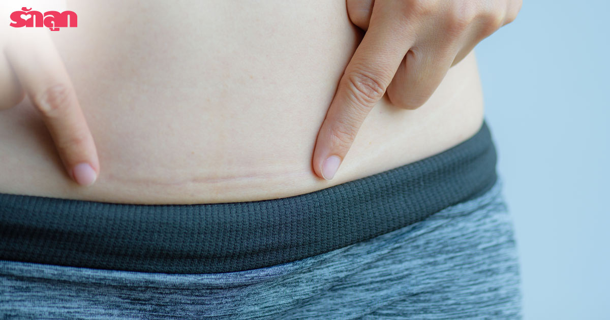 ปัญหาผิวแม่ท้อง, แม่ท้องผิวแตกลาย, วิธีดูแลผิวแม่ท้อง, แผลผ่าคลอด, แม่ท้องผิวแห้ง, คนท้องผิวแห้ง, ออยล์สำหรับแม่ท้อง,ไบโอออยล์ เนเชอรัล คุณสมบัติ, Bio Oil, ออยล์ทาผิว คนท้อง, ออยล์ ท้องแตกลาย, ออยล์ สำหรับคนท้อง, ไบโอออยล์ ดีไหม, ไบโอออยล์ ราคา, ครีมทาผิวแม่ท้อง, โลชั่นแม่ท้อง