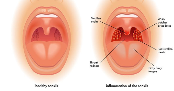 โรคคออักเสบ,ต่อมทอนซิลอักเสบ,โรคที่เด็กๆ ต้องเจอ,อักเสบ,คออักเสบ,ต่อมทอนซิล