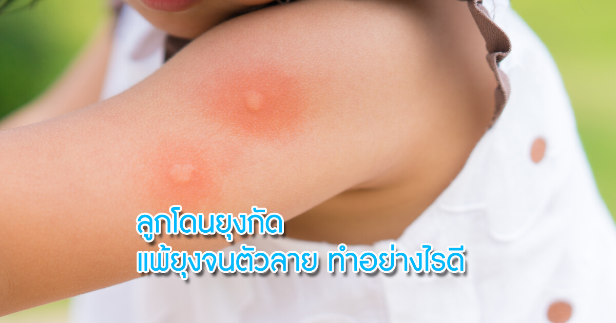 ยุงกัด,ยุงลาย,แผลเป็น,แผลเป็นจากยุง,กำจัดยุง,คันจากยุง,บรรเทาอาการคัน,คันจากยุง,ไข้เลือดออก, ลูกโดนยุงกัด, ลูกแพ้ยุง, ลูกใช้ยากันยุงได้มั้ย
