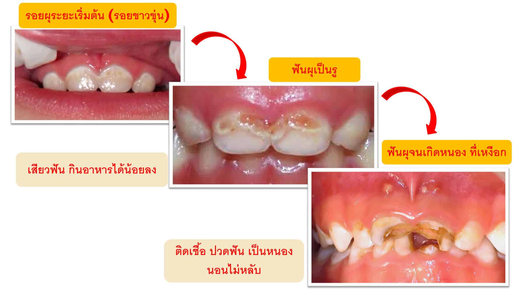 ฟันผุ-ฟันน้ำนม-โรคฟันผุ-ฟันซี่แรก