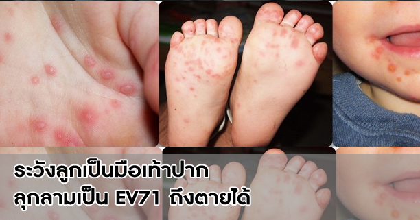มือเท้าปาก,ไวรัส,ไวรัสมือเท้าปาก,hfmd,ev71,Enterovirus 71,เชื้อเอนเทอโรไวรัสสายพันธุ์71,โรคมือเท้าปาก,ระวังโรค,ลูกป่วย,ลูกเป็นมือเท้าปาก,มือเท้าปากในเด็ก,