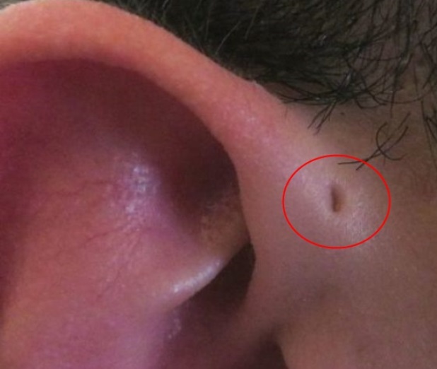 Ear pit, รูหูอักเสบ, มีรูตรงหู, Ear pit อักเสบ, การผ่า Ear pit, โรคภัยในเด็ก, เด็กเรียนว่ายน้ำ, ภัยเงียบ, การเลี้ยงลูกวัย 1-3 ปี