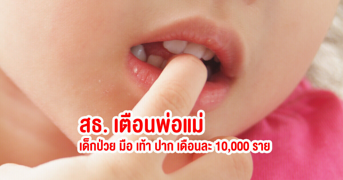 โรคหน้าฝน, มือเท้าปาก, ลูกเป็นมือเท้าปาก, โรคมือเท้าปาก, เด็กป่วย, เด็กป่วยเป็นมือเท้าปาก