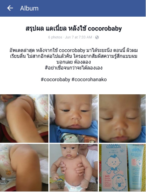 Cocoro Baby Natural Sensitive Skin, ลูกผิวแห้ง, ลูกผิงแห้งมาก, ลูกผิวแห้งสาก, ลูกผิวแห้งลอก, ลูกผิวแห้งเป็นขุย, ลูกผิวขาดความชุ่มชื่น, ลูกผิวแพ้ง่าย, ลูกเป้นผื่นง่าย, ลูกผิวบอบบาง, ลูกผิวแห้งมากทำไงดี, ลูกผิวลอกเป็นขุยทำไงดี, อยากได้ครีมทาผิวลูกแห้งขุย, ผื่นภูมิแพ้, ผิวแห้งอักเสบ, ครีมบำรุงผิว, ผื่น คัน, ผด ผื่น, ผด, ผื่น, ผื่น แดง, ผด ร้อน, ผื่น คัน เกา แล้ว ลาม, ผื่น แดง คัน, ผื่น แดง เป็น ปื้น คัน, ตุ่ม คัน, ผื่น ขึ้น ตาม ตัว, ผื่น แดง ขึ้น ตาม ตัว, ผื่น แพ้, เป็น ผื่น คัน, ผื่น แพ้ ยา, ผื่น คัน ตาม ตัว, เป็น ผื่น แดง, ผื่น คัน ที่ ขา, ตุ่ม แดง คัน ที่ ขา, ผื่น แพ้ อากาศ, ตุ่ม แดง ขึ้น ตาม ตัว, ผื่น ขึ้น, ผื่น แพ้ ผิวหนัง, ผื่น คัน แพ้ อากาศ, ครีม แก้ แพ้, ผื่น คัน ขึ้น ตาม ตัว, อาการ ผื่น คัน, ตุ่ม คัน ขึ้น ตาม ตัว, คัน ตาม ตัว มี ผื่น ขึ้น, เป็น ผื่น, ตุ่ม แดง ขึ้น ตาม ตัว คัน, ผื่น ขึ้น หลัง, มี ผื่น แดง ขึ้น ตาม ตัว, มี ผื่น แดง ขึ้น ตาม ตัว คัน, ผื่น ขึ้น แขน, ผื่น แดง ตาม ตัว, ผด ผื่น คัน, เป็น ผื่น ที่ คอ, มี ตุ่ม ขึ้น ตาม ตัว คัน, ผื่น คัน ที่ คอ, เป็น ผื่น ที่ แขน, ตุ่ม แดง คัน ขึ้น ตาม ตัว, ยา ทา ผื่น ผ้าอ้อม, ผื่น แดง ที่ คอ, ผื่น ขึ้น คอ, มี ผื่น ขึ้น ตาม ตัว, มี ตุ่ม แดง ขึ้น ตาม ตัว, ผด ผื่น ร้อน, ผื่น ขึ้น ตาม ตัว คัน, ครีม ทา ผื่น ผ้าอ้อม, เป็น ผื่น คัน ที่ ขา, ตุ่ม แพ้, เป็น ผื่น แดง คัน, แก้ ผื่น คัน, ผื่น คัน ที่ แขน, ผื่น ขึ้น ขา, เป็น ผื่น คัน ตาม ตัว, ผื่น ขึ้น ทั้ง ตัว, ผื่น แดง คัน ขึ้น ตาม ตัว, ผด ผื่น ตาม ตัว, ผื่น แดง ที่ แขน, อาการ คัน ตาม ตัว ผื่น แดง, ผื่น คัน ทั้ง ตัว, ผื่น ที่ คอ, ตุ่ม คัน ตาม ตัว, คัน เป็น ผื่น แดง, แพ้ อากาศ คัน, เป็น ผื่น คัน ทั้ง ตัว, เป็น ผื่น แดง ตาม ตัว, ผื่น คัน แดง, อาการ ผื่น แดง, เป็น ตุ่ม คัน ตาม ตัว, ผื่น ขึ้น ตัว, มี ตุ่ม คัน ขึ้น ตาม ตัว, คัน ตาม ตัว ไม่มี ผื่น, คัน เป็น ผื่น, ผื่น แดง คัน ตาม ตัว, ตุ่ม ผื่น คัน, ครีม ทา แก้ แพ้, ผื่น คัน เกิด จาก, มี ตุ่ม แดง ขึ้น ตาม ตัว คัน, มี ผื่น ขึ้น ที่ ขา, คัน ผิวหนัง ไม่มี ผื่น, รักษา ผื่น คัน, ผื่น แดง คัน ที่ ขา, ผด เหงื่อ, คัน ผื่น แดง, ยา รักษา ผื่น คัน, ผื่น คัน เกา แล้ว ลาม รักษา, ตุ่ม ภูมิแพ้, ยา ทา ผื่น เด็ก, ผด ผื่น ขึ้น ตาม ตัว, ผื่น ขึ้น ที่ แขน, ผื่น ผิวหนัง, เป็น ผื่น ตาม ตัว, โรค ผื่น คัน, เป็น ผื่น คัน ที่ แขน, ผด ขึ้น ตาม ตัว, เป็น ผื่น คัน ที่ คอ, ตุ่ม คัน ที่ แขน, ครีมทาผดผื่น ยี่ห้อ ไหน ดี , Cocoro Baby รีวิว, Cocoro Baby พันทิป, Cocoro Baby รีวิว พันทิป, ครีมทาผดผื่น ยี่ห้อ อะไร ดี , Cocoro Baby ราคา, Cocoro Baby ราคาถูก, Cocoro Baby ซื้อ, Cocoro Baby ซื้อ ที่ไหน, ครีมทาผดผื่น อะไร ดี