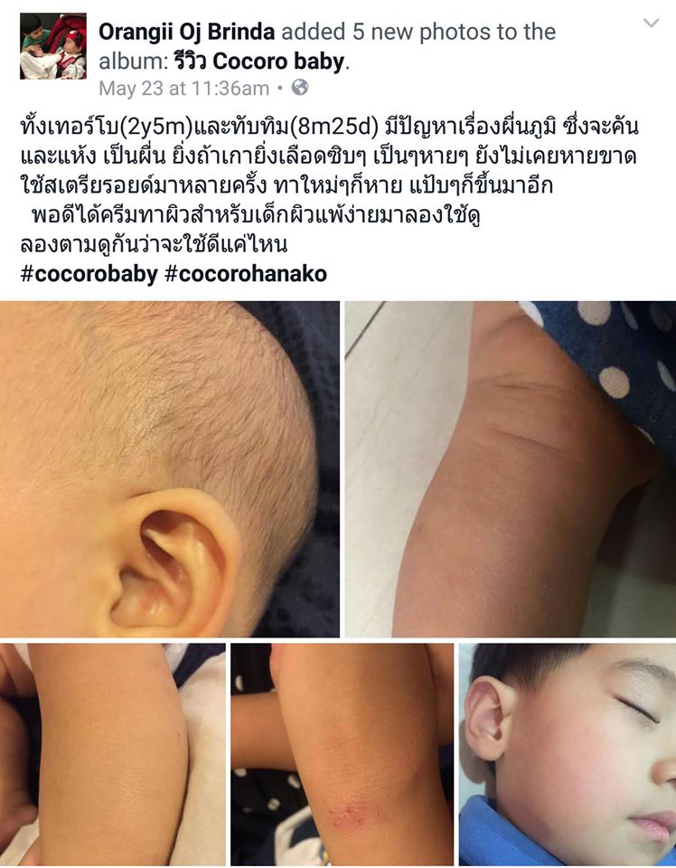 Cocoro Baby Natural Sensitive Skin, ลูกผิวแห้ง, ลูกผิงแห้งมาก, ลูกผิวแห้งสาก, ลูกผิวแห้งลอก, ลูกผิวแห้งเป็นขุย, ลูกผิวขาดความชุ่มชื่น, ลูกผิวแพ้ง่าย, ลูกเป้นผื่นง่าย, ลูกผิวบอบบาง, ลูกผิวแห้งมากทำไงดี, ลูกผิวลอกเป็นขุยทำไงดี, อยากได้ครีมทาผิวลูกแห้งขุย, ผื่นภูมิแพ้, ผิวแห้งอักเสบ, ครีมบำรุงผิว, ผื่น คัน, ผด ผื่น, ผด, ผื่น, ผื่น แดง, ผด ร้อน, ผื่น คัน เกา แล้ว ลาม, ผื่น แดง คัน, ผื่น แดง เป็น ปื้น คัน, ตุ่ม คัน, ผื่น ขึ้น ตาม ตัว, ผื่น แดง ขึ้น ตาม ตัว, ผื่น แพ้, เป็น ผื่น คัน, ผื่น แพ้ ยา, ผื่น คัน ตาม ตัว, เป็น ผื่น แดง, ผื่น คัน ที่ ขา, ตุ่ม แดง คัน ที่ ขา, ผื่น แพ้ อากาศ, ตุ่ม แดง ขึ้น ตาม ตัว, ผื่น ขึ้น, ผื่น แพ้ ผิวหนัง, ผื่น คัน แพ้ อากาศ, ครีม แก้ แพ้, ผื่น คัน ขึ้น ตาม ตัว, อาการ ผื่น คัน, ตุ่ม คัน ขึ้น ตาม ตัว, คัน ตาม ตัว มี ผื่น ขึ้น, เป็น ผื่น, ตุ่ม แดง ขึ้น ตาม ตัว คัน, ผื่น ขึ้น หลัง, มี ผื่น แดง ขึ้น ตาม ตัว, มี ผื่น แดง ขึ้น ตาม ตัว คัน, ผื่น ขึ้น แขน, ผื่น แดง ตาม ตัว, ผด ผื่น คัน, เป็น ผื่น ที่ คอ, มี ตุ่ม ขึ้น ตาม ตัว คัน, ผื่น คัน ที่ คอ, เป็น ผื่น ที่ แขน, ตุ่ม แดง คัน ขึ้น ตาม ตัว, ยา ทา ผื่น ผ้าอ้อม, ผื่น แดง ที่ คอ, ผื่น ขึ้น คอ, มี ผื่น ขึ้น ตาม ตัว, มี ตุ่ม แดง ขึ้น ตาม ตัว, ผด ผื่น ร้อน, ผื่น ขึ้น ตาม ตัว คัน, ครีม ทา ผื่น ผ้าอ้อม, เป็น ผื่น คัน ที่ ขา, ตุ่ม แพ้, เป็น ผื่น แดง คัน, แก้ ผื่น คัน, ผื่น คัน ที่ แขน, ผื่น ขึ้น ขา, เป็น ผื่น คัน ตาม ตัว, ผื่น ขึ้น ทั้ง ตัว, ผื่น แดง คัน ขึ้น ตาม ตัว, ผด ผื่น ตาม ตัว, ผื่น แดง ที่ แขน, อาการ คัน ตาม ตัว ผื่น แดง, ผื่น คัน ทั้ง ตัว, ผื่น ที่ คอ, ตุ่ม คัน ตาม ตัว, คัน เป็น ผื่น แดง, แพ้ อากาศ คัน, เป็น ผื่น คัน ทั้ง ตัว, เป็น ผื่น แดง ตาม ตัว, ผื่น คัน แดง, อาการ ผื่น แดง, เป็น ตุ่ม คัน ตาม ตัว, ผื่น ขึ้น ตัว, มี ตุ่ม คัน ขึ้น ตาม ตัว, คัน ตาม ตัว ไม่มี ผื่น, คัน เป็น ผื่น, ผื่น แดง คัน ตาม ตัว, ตุ่ม ผื่น คัน, ครีม ทา แก้ แพ้, ผื่น คัน เกิด จาก, มี ตุ่ม แดง ขึ้น ตาม ตัว คัน, มี ผื่น ขึ้น ที่ ขา, คัน ผิวหนัง ไม่มี ผื่น, รักษา ผื่น คัน, ผื่น แดง คัน ที่ ขา, ผด เหงื่อ, คัน ผื่น แดง, ยา รักษา ผื่น คัน, ผื่น คัน เกา แล้ว ลาม รักษา, ตุ่ม ภูมิแพ้, ยา ทา ผื่น เด็ก, ผด ผื่น ขึ้น ตาม ตัว, ผื่น ขึ้น ที่ แขน, ผื่น ผิวหนัง, เป็น ผื่น ตาม ตัว, โรค ผื่น คัน, เป็น ผื่น คัน ที่ แขน, ผด ขึ้น ตาม ตัว, เป็น ผื่น คัน ที่ คอ, ตุ่ม คัน ที่ แขน, ครีมทาผดผื่น ยี่ห้อ ไหน ดี , Cocoro Baby รีวิว, Cocoro Baby พันทิป, Cocoro Baby รีวิว พันทิป, ครีมทาผดผื่น ยี่ห้อ อะไร ดี , Cocoro Baby ราคา, Cocoro Baby ราคาถูก, Cocoro Baby ซื้อ, Cocoro Baby ซื้อ ที่ไหน, ครีมทาผดผื่น อะไร ดี